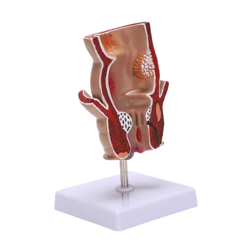 Anatomia Modelo Humanos Retal Hemorróidas Lesão Modelo De Hemorróidas, Fístula Fístula Fissura Patologia Modelo De Ensino